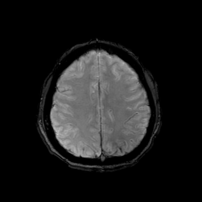 Cerebral paragonimiasis (Radiopaedia 73473-84238 Axial SWI 50).jpg