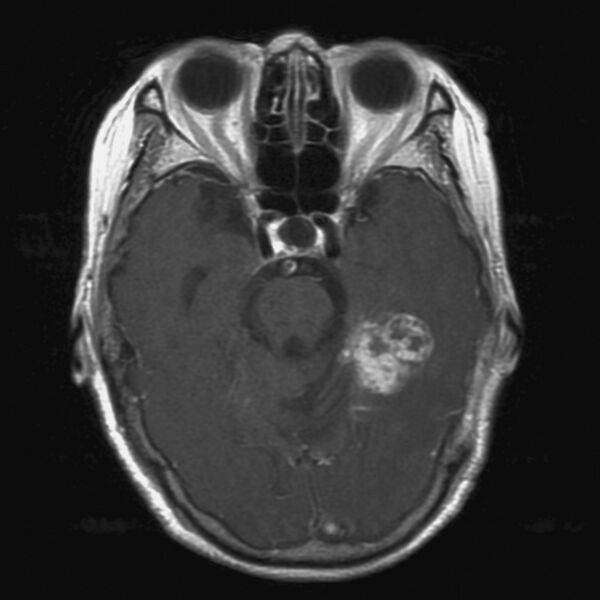 File:Cerebral radiation necrosis (Radiopaedia 7248-8188 Axial T1 C+ fat sat 1).jpg
