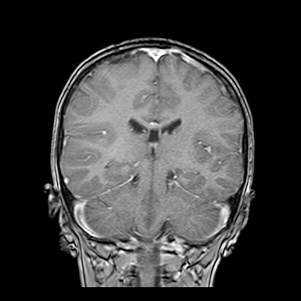 File:Cerebral tuberculoma (Radiopaedia 41152-43932 Coronal T1 C+ 12).jpg