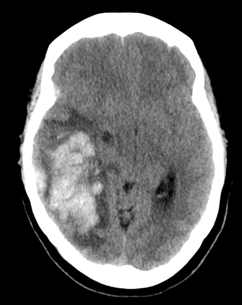 File:Cerebral venous infarct related to dural venous sinus thromboses (Radiopaedia 35292-36803 AXIAL THICK 12).png