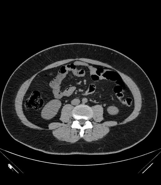 File:Cervical aortic arch with coarctation and aneurysms (Radiopaedia 44035-47552 Axial non-contrast 66).jpg