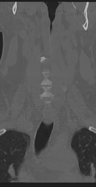 File:Cervical canal stenosis due to ossification of the posterior longitudinal ligament (Radiopaedia 47260-51823 Coronal bone window 11).png