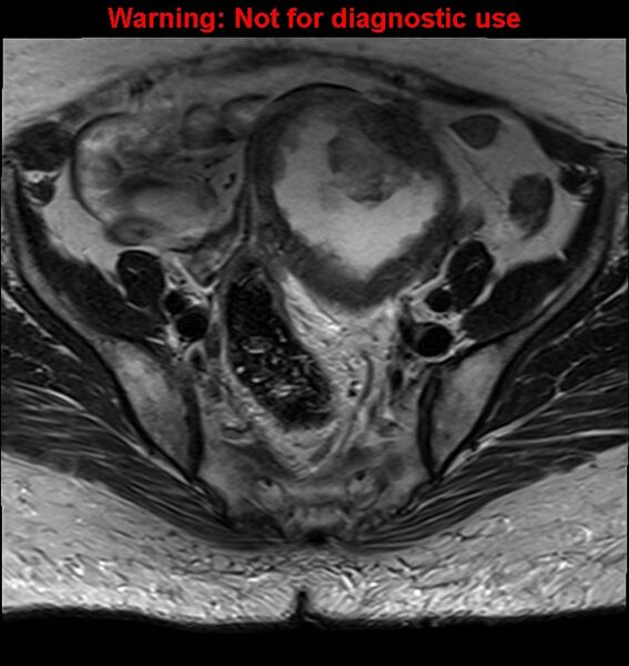 File:Cervical cancer (Radiopaedia 24151-24410 Axial T2 9).jpg