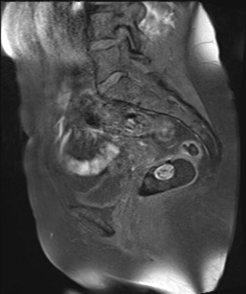 File:Cervical carcinoma (Radiopaedia 88312-104943 Sagittal T1 fat sat 14).jpg