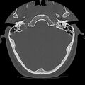 Cervical flexion teardrop fracture with cord hemorrhage (Radiopaedia 32497-33454 Axial bone window 1).jpg