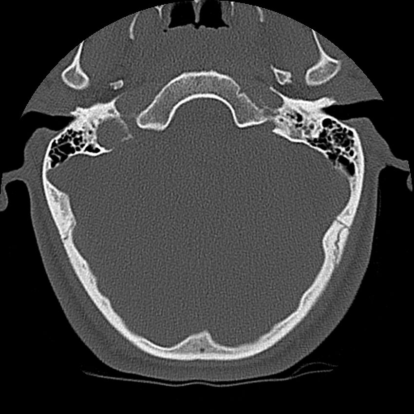 Cervical flexion teardrop fracture with cord hemorrhage (Radiopaedia 32497-33454 Axial bone window 1).jpg