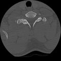 Cervical flexion teardrop fracture with cord hemorrhage (Radiopaedia 32497-33454 Axial bone window 69).jpg