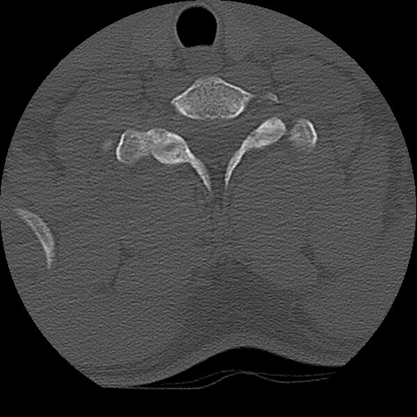 File:Cervical flexion teardrop fracture with cord hemorrhage (Radiopaedia 32497-33454 Axial bone window 69).jpg