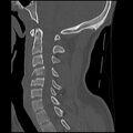 Cervical flexion teardrop fracture with cord hemorrhage (Radiopaedia 32497-33454 Sagittal bone window 22).jpg