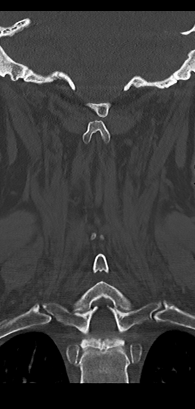 File:Cervical spine fracture - chalk stick (Radiopaedia 39116-41323 Coronal bone window 37).png