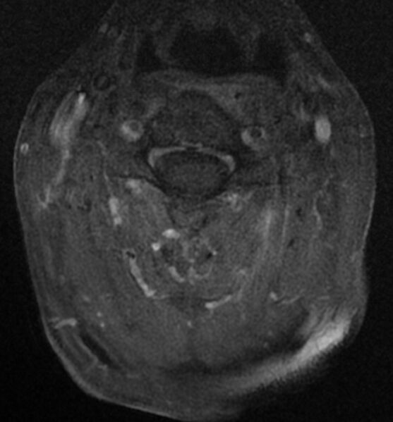 File:Cervical spondylodiscitis (Radiopaedia 81362-95110 Axial T1 C+ fat sat 7).jpg