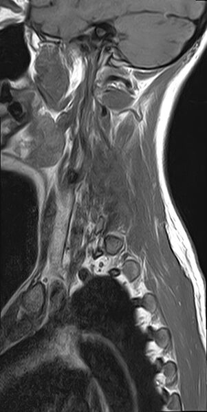 File:Cervical spondylodiscitis and calvarial hemangioma (Radiopaedia 64317-73104 Sagittal T1 13).jpg
