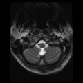 Cervical vertebrae metastasis (Radiopaedia 78814-91667 Axial T2 28).png