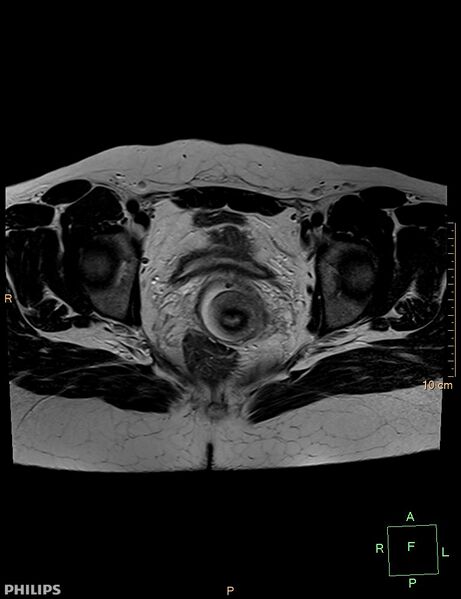 File:Cesarian scar endometriosis (Radiopaedia 68495-78066 Axial T2 17).jpg