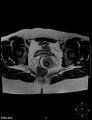 Cesarian scar endometriosis (Radiopaedia 68495-78066 Axial T2 17).jpg