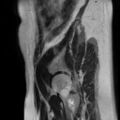 Cesarian section scar endometriosis (Radiopaedia 66520-75799 Sagittal T2 20).jpg