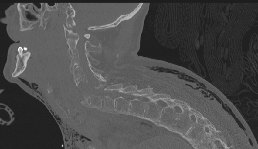 Chalk stick fracture (Radiopaedia 57948-64928 Sagittal bone window 25).png