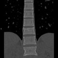 Chance fracture (Radiopaedia 36521-38081 Coronal bone window 18).jpg