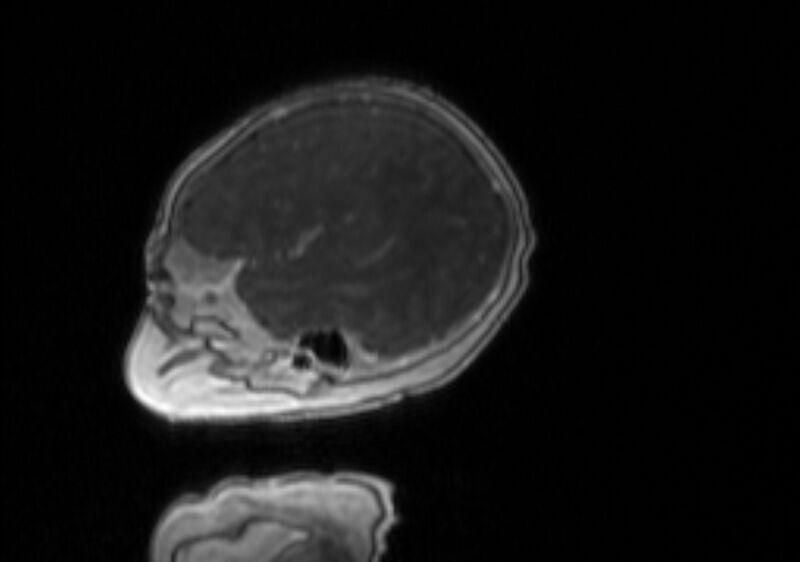 File:Chiari III malformation with occipital encephalocele (Radiopaedia 79446-92559 Sagittal T1 C+ mpr 53).jpg