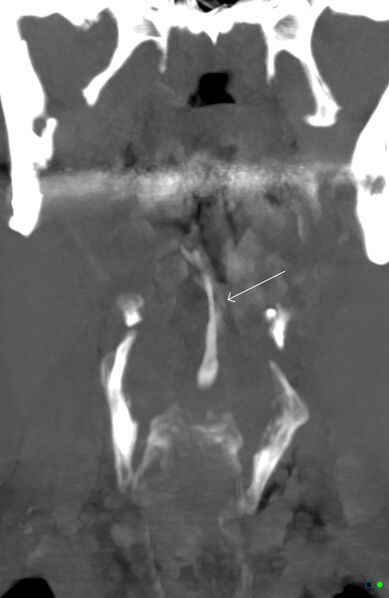 File:Chicken bone (fibula) perforation of the pharynx (Radiopaedia 21332-21261 B 1).jpg