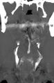 Chicken bone (fibula) perforation of the pharynx (Radiopaedia 21332-21261 B 1).jpg