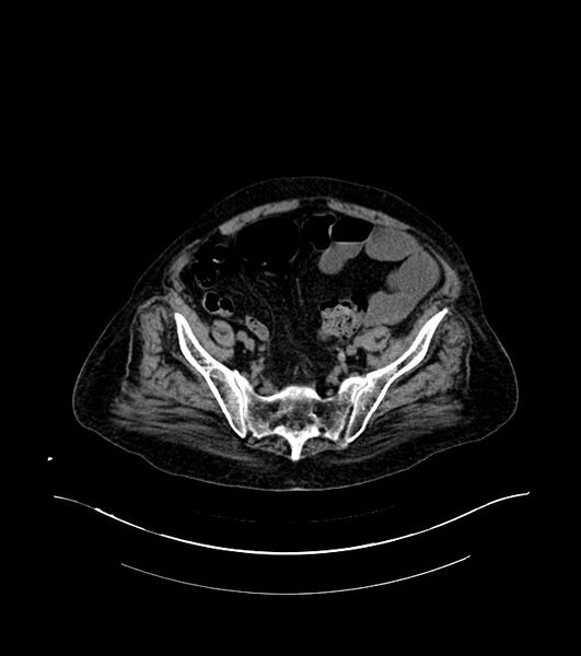 File:Cholangiocarcinoma with cerebral metastases (Radiopaedia 83519-98629 Axial non-contrast 99).jpg