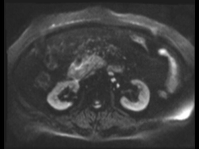 File:Choledocholithiasis causing intrahepatic biliary duct dilation (Radiopaedia 39908-42369 Axial T2 SPAIR 30).jpg