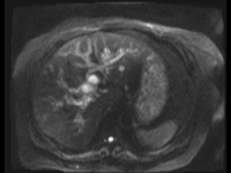 File:Choledocholithiasis causing intrahepatic biliary duct dilation (Radiopaedia 39908-42369 Axial T2 SPAIR 48).jpg