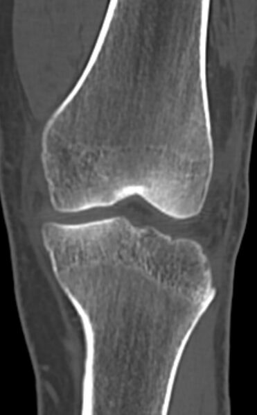 File:Chondrocalcinosis (Radiopaedia 82862-97173 Coronal bone window 32).jpg