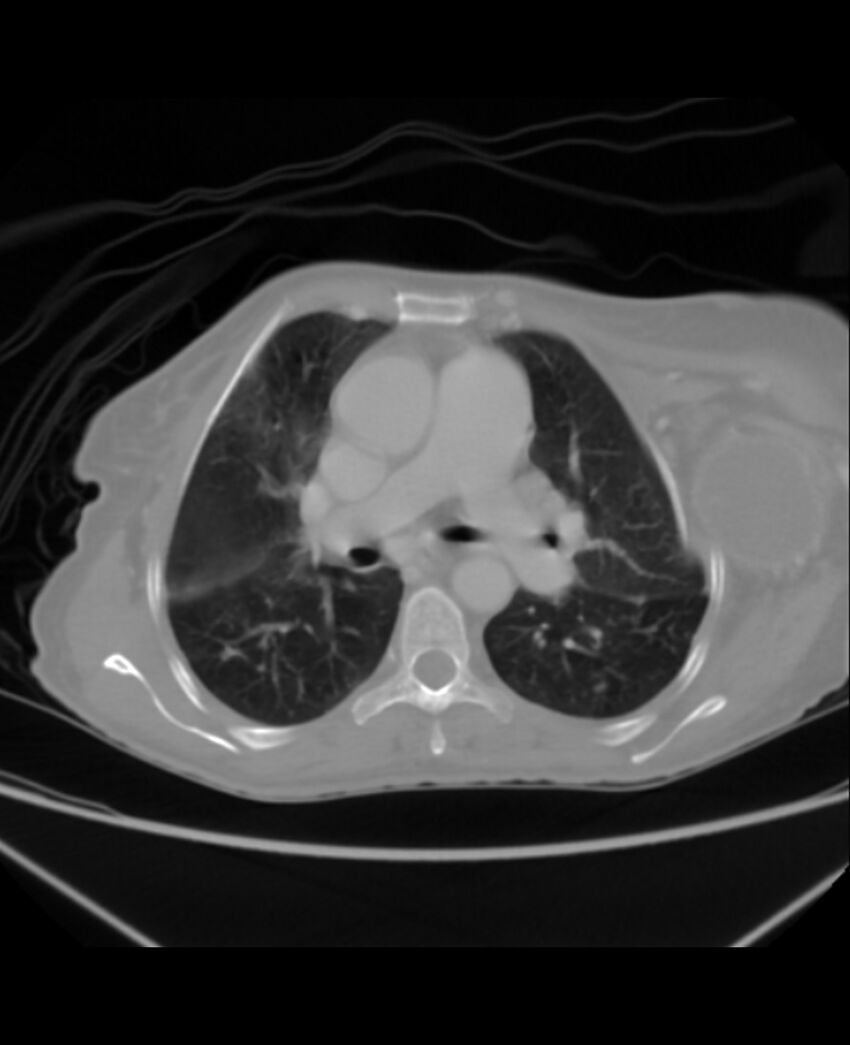Chondrosarcoma (Radiopaedia 79427-92535 Axial lung window 22).jpg