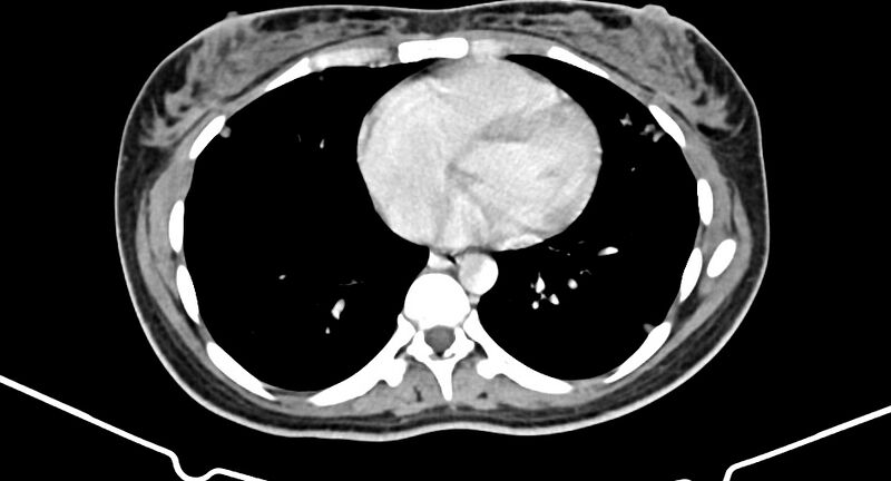 File:Choriocarcinoma liver metastases (Radiopaedia 74768-85766 A 12).jpg