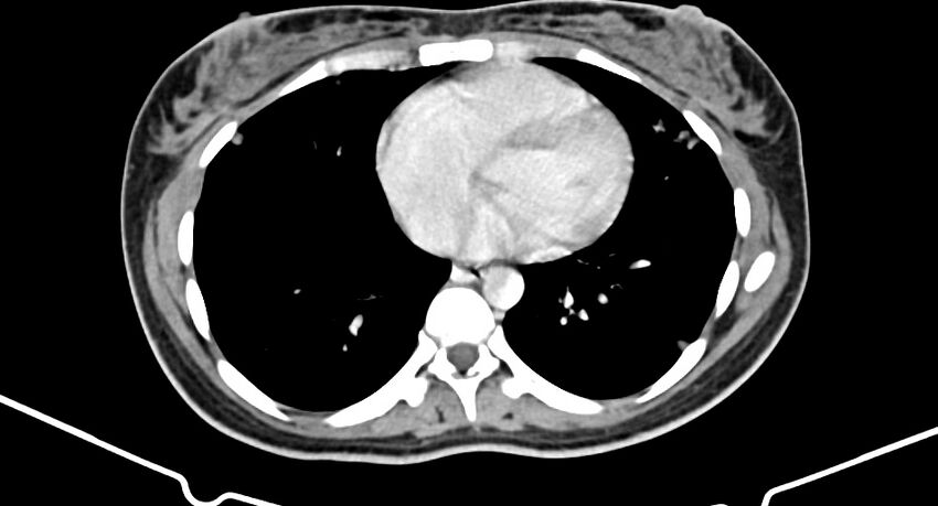 Choriocarcinoma liver metastases (Radiopaedia 74768-85766 A 12).jpg