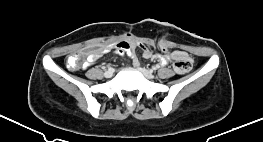 Choriocarcinoma liver metastases (Radiopaedia 74768-85766 A 147).jpg