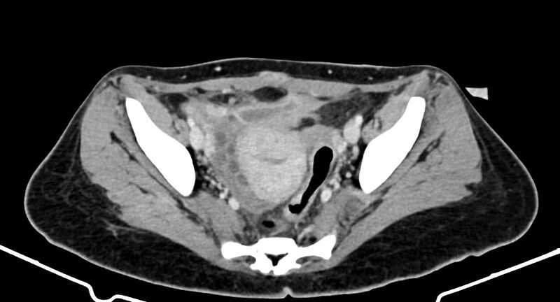 File:Choriocarcinoma liver metastases (Radiopaedia 74768-85766 A 174).jpg