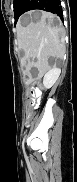 File:Choriocarcinoma liver metastases (Radiopaedia 74768-85766 C 132).jpg