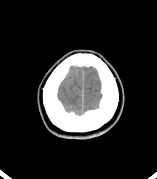 File:Choroid plexus carcinoma (Radiopaedia 91013-108552 Axial non-contrast 56).jpg