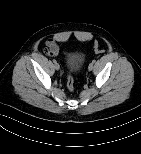 File:Chromophobe renal cell carcinoma (Radiopaedia 84286-99573 Axial non-contrast 54).jpg