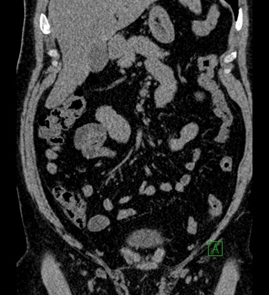 File:Chromophobe renal cell carcinoma (Radiopaedia 84286-99573 Coronal non-contrast 59).jpg