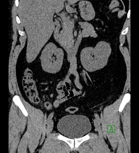 File:Chromophobe renal cell carcinoma (Radiopaedia 84286-99573 Coronal non-contrast 81).jpg