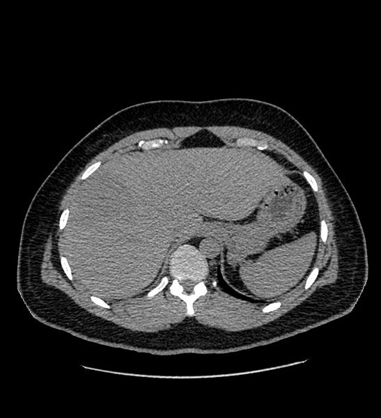File:Chromophobe renal cell carcinoma (Radiopaedia 84337-99693 Axial non-contrast 15).jpg