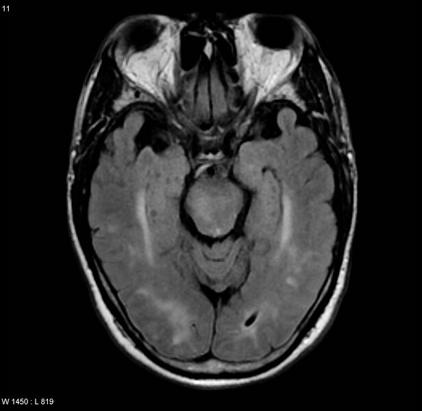 File:Chronic hypertensive encephalopathy (Radiopaedia 4564-6686 Axial FLAIR 4).jpg