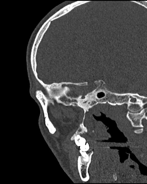 File:Chronic maxillary sinusitis caused by a foreign body (Radiopaedia 58521-65676 Sagittal bone window 63).jpg