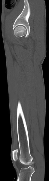File:Chronic osteomyelitis (with sequestrum) (Radiopaedia 74813-85822 C 32).jpg
