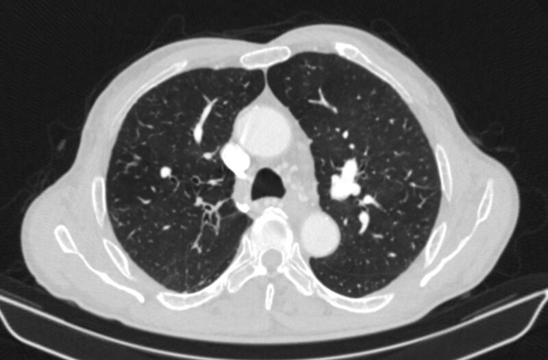 File:Chronic pulmonary embolism (Radiopaedia 91241-108843 Axial lung window 31).jpg