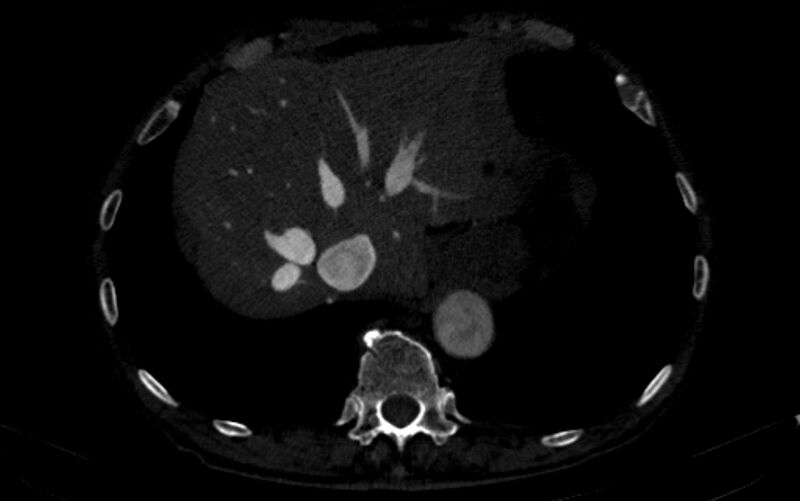 File:Chronic pulmonary embolism (Radiopaedia 91241-108843 B 167).jpg