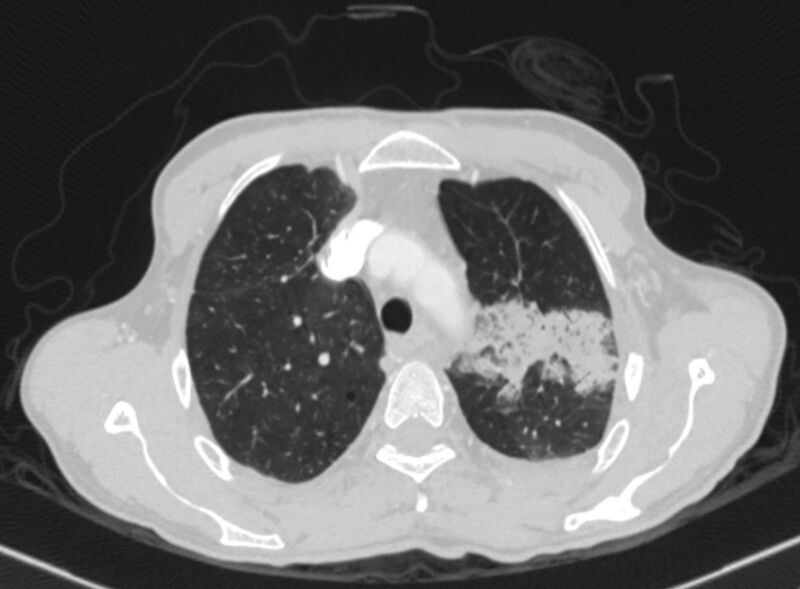 File:Chronic pulmonary embolism with bubbly consolidation (Radiopaedia 91248-108850 Axial lung window 35).jpg