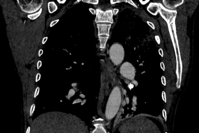 File:Chronic pulmonary embolism with bubbly consolidation (Radiopaedia 91248-108850 B 94).jpg