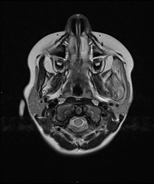 File:Chronic reactive multifocal osteomyelitis (CRMO) - mandible (Radiopaedia 56405-63069 Axial T2 16).jpg
