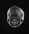 Chronic reactive multifocal osteomyelitis (CRMO) - mandible (Radiopaedia 56405-63069 Axial T2 8).jpg