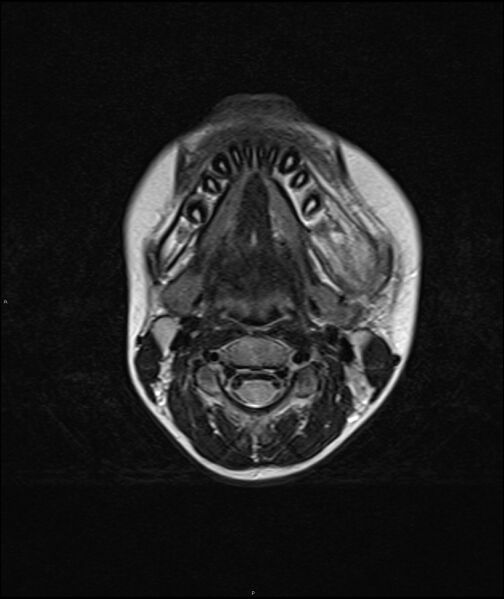 File:Chronic reactive multifocal osteomyelitis (CRMO) - mandible (Radiopaedia 56405-63069 Axial T2 8).jpg
